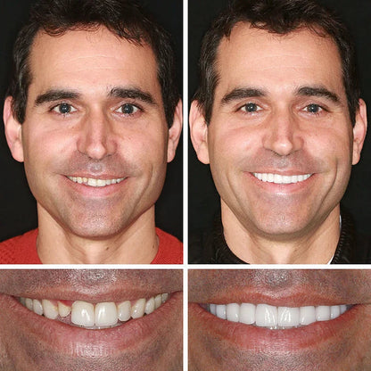 ⚡ 🌎Ends Today: 70% OFF! ⏰ Medical Full Denture with Strong Suctiond