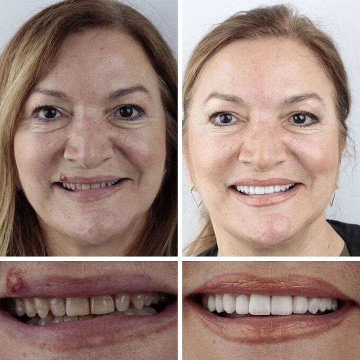🔥🔥Ends Today: 75% OFF!🦷 DarkFairy™ Custom-Fit Denture