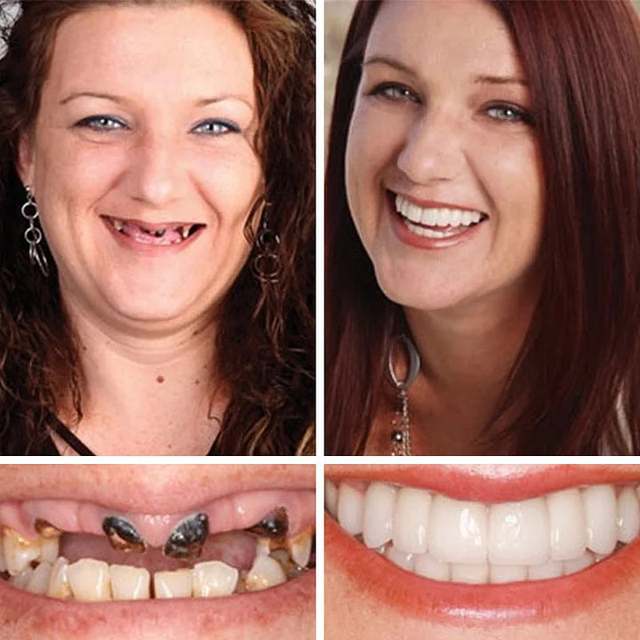 🔥🔥Ends Today: 75% OFF!🦷 DarkFairy™ Custom-Fit Denture