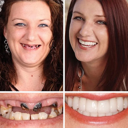 🔥🔥Ends Today: 75% OFF!🦷 DarkFairy™ Custom-Fit Denture