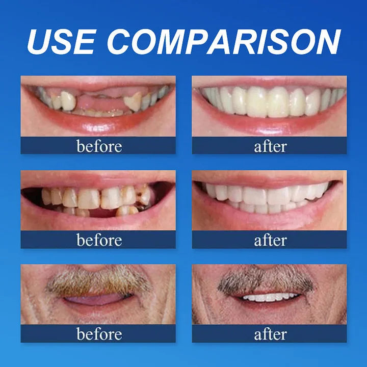 🔥🔥Ends Today: 75% OFF!🦷 DarkFairy™ Custom-Fit Denture